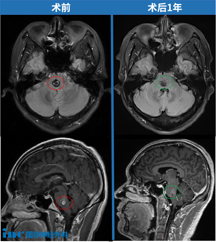 手术结束了,一切都顺利
