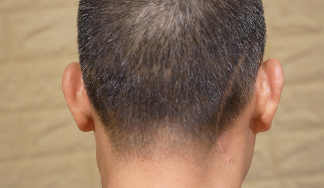 刘先生请理发师在手术切口的对侧也推一条对称的线条