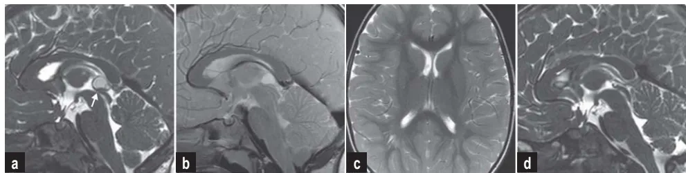 a) 矢状位CISS图像显示导水管入口明显狭窄（箭头处）  b) IRTSE图像显示导水管内脑脊液流动正常  c) 术前T2加权像显示正常宽度的侧脑室  d) 术后确认囊肿完全切除