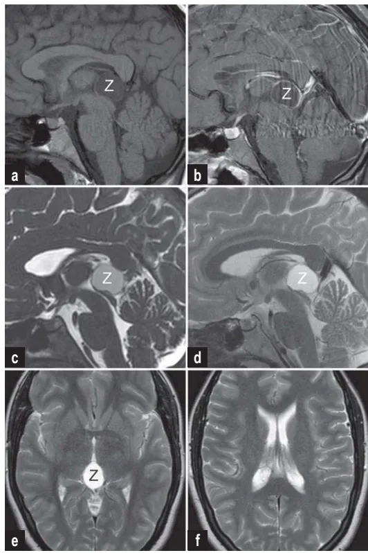 a) 平扫T1加权像显示松果体区低信号占位病变  b) 增强扫描显示典型的囊肿膜球形强化  c,d) 矢状位CISS和T2加权像显示导水管入口轻度狭窄  e,f) T2加权轴位图像显示狭窄的第三脑室和未扩大的侧脑室