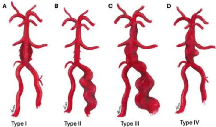 DVBAs分为四型：I型（梭形）、II型（梭形扩张型）、III型（过渡型）和IV型（伴有囊状憩室）。