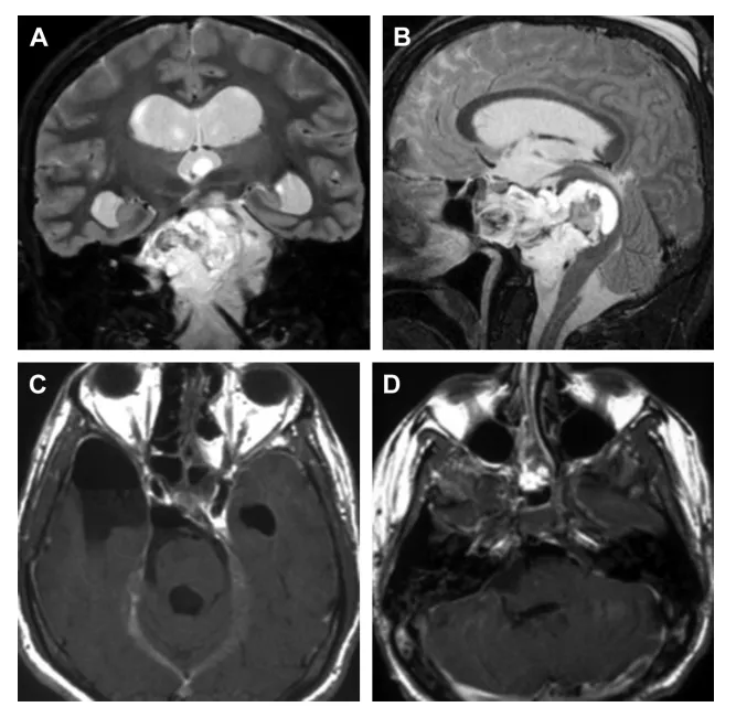 一个深部脑瘤，为何需要3种手术入路来解除？INC国际大咖如何“包抄”复杂脊