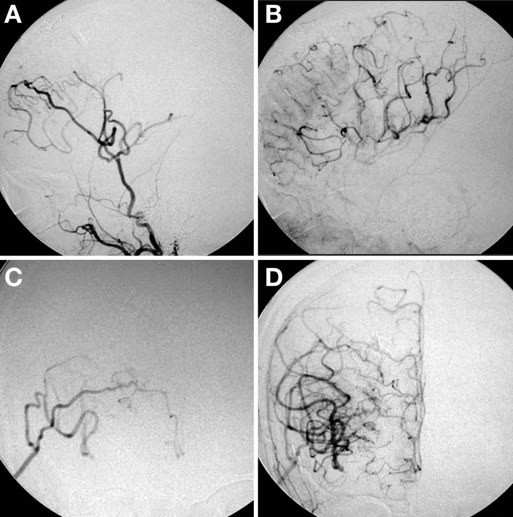 吴女士术后11天的术后血管造影。右侧颈外动脉血管造影的侧视图（A、B）和右侧颈外血管血管造影的前后视图（C、D）显示颞浅动脉ACA和颞浅动脉MCA旁路的良好通畅性。