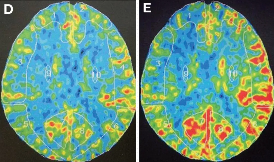 术前氙CT脑血流检测：双侧大脑前动脉和右侧大脑中动脉区域的脑血流减少，血管反应性差。