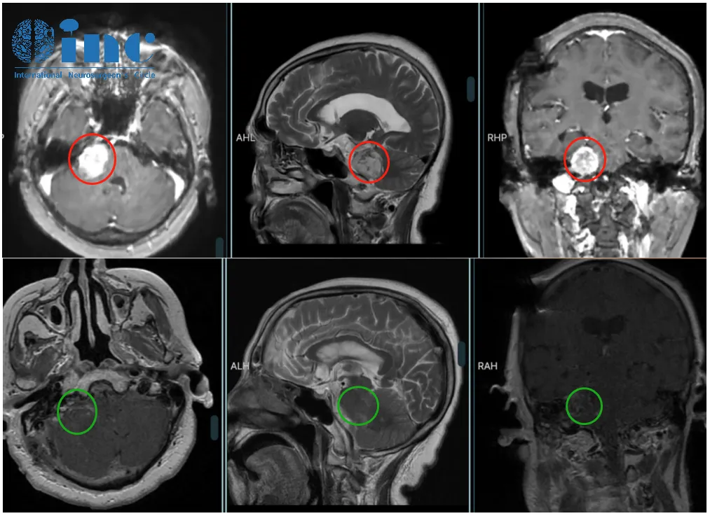 78岁，确诊听神经瘤仅一年，肿瘤便迅速增长至超过3厘米，属于大型听神经瘤。