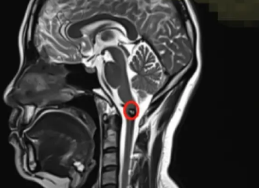急性血管团，确诊延髓海绵状血管瘤。