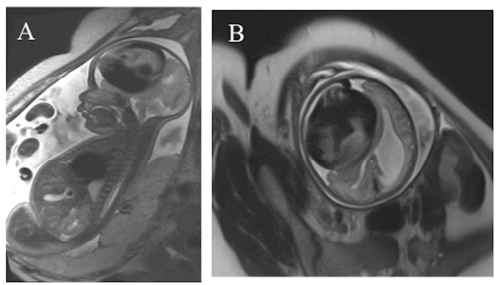 医生直呼罕见！胎儿脑中惊现“大圆球”，剖腹产后情况更棘手