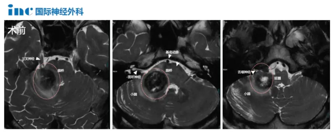 海绵状血管瘤切除术