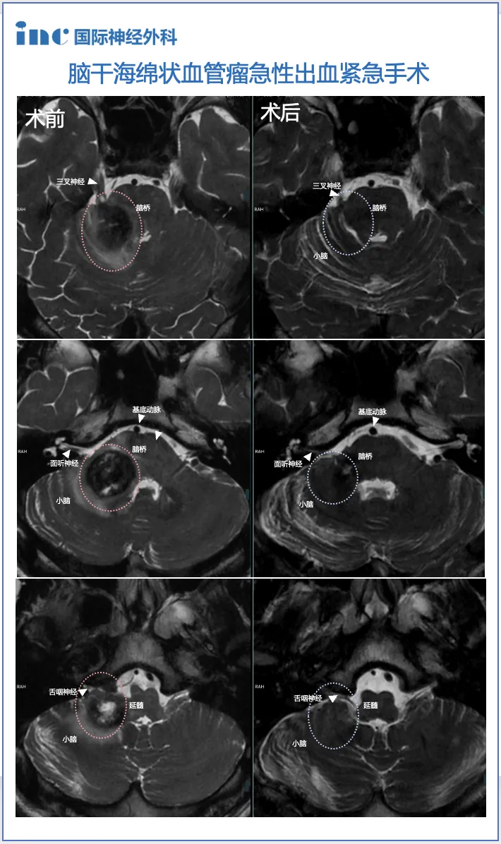 脑干海绵状血管瘤急性出血紧急手术术前术后对比