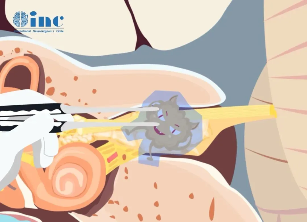 肿瘤残留率与复发风险呈正相关，追求更高的切除率，是降低复发的重要手段。