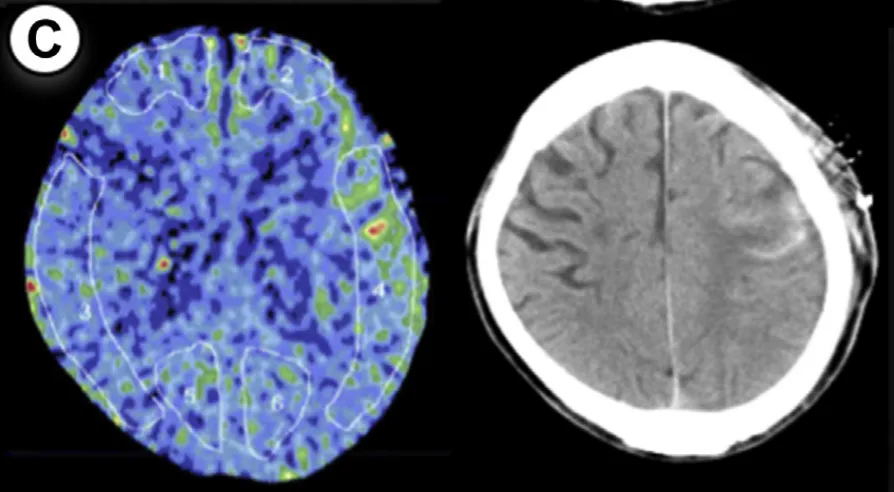 因缺血性卒中确诊