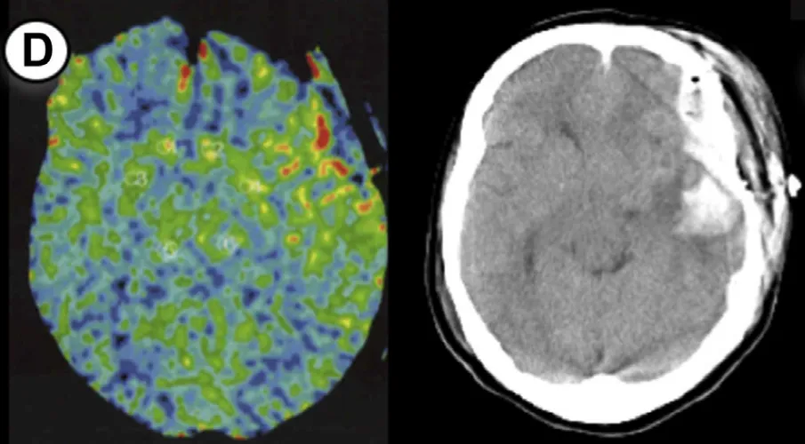 短暂性脑缺血发作（TIA）病史