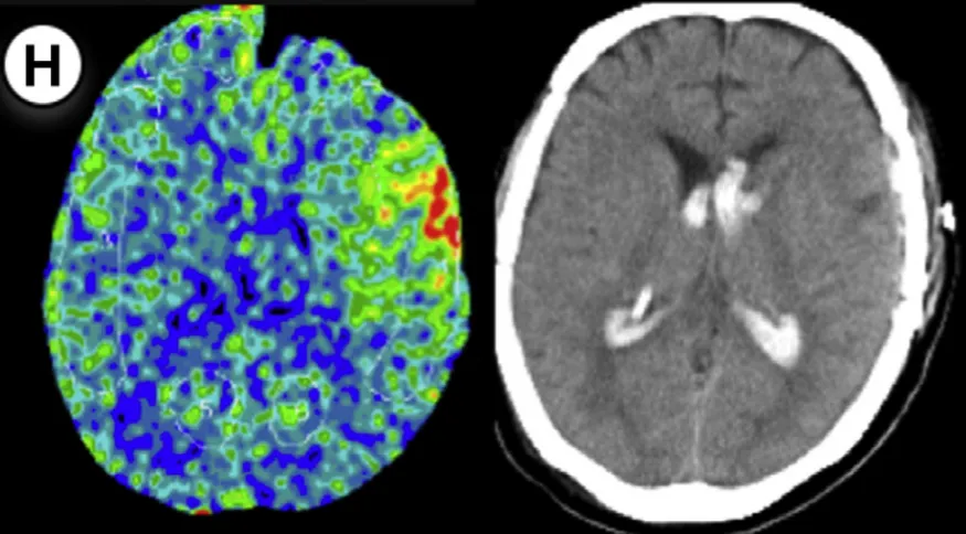 对侧大脑曾接受手术