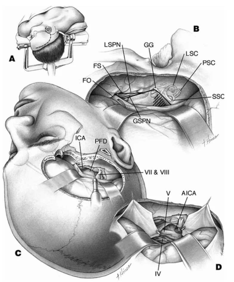 (Kawase入路的解剖结构)