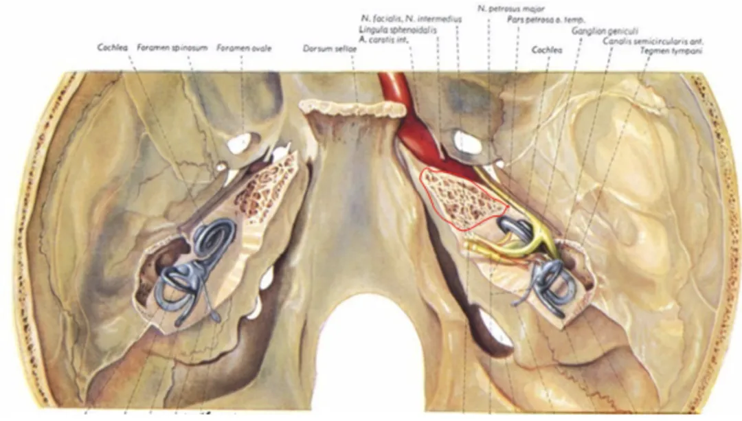 (红色部分为被磨除的Kawase三角区)