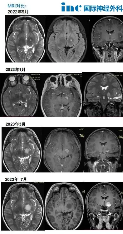 激光间质热疗LITT