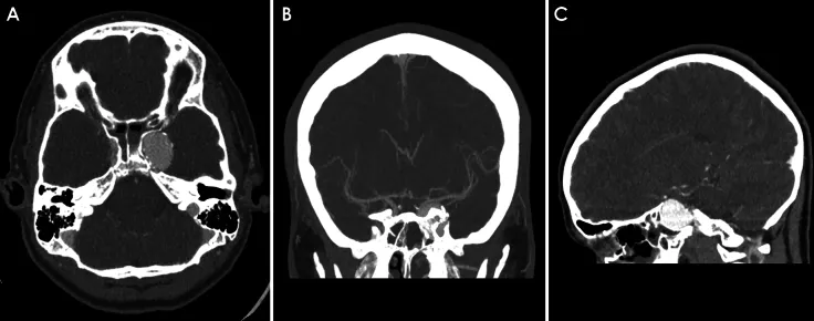 图1：轴位、冠状位和矢状位CT血管造影图像，显示左侧颈内动脉海绵窦段巨大动脉瘤伴蝶骨重塑，未见蛛网膜下腔出血证据。  数字减影血管造影（DSA）显示基底动脉顶端动脉瘤（BTA）部分血栓形成，左侧大脑后动脉自动脉瘤发出。右侧大脑后动脉及双侧小脑上动脉未见明确显影，其血供来源于小脑前下动脉的软脑膜侧支循环。左侧颈内动脉动脉瘤大小为16.9 × 25.9 × 20.5 mm。  图片 图2，A：轴位CT血管造影显示巨大基底动脉瘤部分血栓形成。B：侧位DSA显示部分血栓形成的BTA动脉瘤。C：前后位投影显示左侧大脑后动脉（PCA）自动脉瘤发出，右侧P1段缺如，左侧P1段狭窄，双侧小脑上动脉缺如。  患者成功接受了椎基底动脉球囊闭塞试验。DSA显示BTA通畅部分及左侧P1段狭窄处发生了部分重塑。患者接受了左枕部开颅手术，行左侧枕动脉至左侧PCA远端分支的EC-IC旁路移植术，并进行硬脑膜-软脑膜血管融合术，以重建左侧PCA区域血供并减少对椎基底动脉循环的需求。术后继续服用阿司匹林。3个月随访影像显示BTA完全闭塞并血栓形成。至左侧PCA区域的颅外-颅内（EC-IC）旁路通畅。左侧颈内动脉海绵窦段动脉瘤无变化。  6个月后，患者接受DSA检查，并行Pipeline血流导向装置置入及左侧颈内动脉巨大动脉瘤弹簧圈栓塞术，两个动脉瘤均完全消失。患者恢复良好，无并发症或神经功能缺损。  图片 图3，A：侧位DSA显示BTA动脉瘤不再充盈。B和C：3个月随访轴位CT血管造影显示BTA动脉瘤完全闭塞并血栓形成，以及左侧颈内动脉海绵窦段动脉瘤无变化。    PART.2   巨大型颅内动脉瘤该如何治疗？   巨大型颅内动脉瘤，尤其是后循环动脉瘤，通常不适合进行血管内弹簧圈栓塞或血流导向装置治疗。在许多情况下，不可预测的血流动力学会导致动脉瘤发生重塑和复发。为引导血流所需的多重支架可能会阻塞穿支血管和分支动脉，从而导致神经功能障碍。由于球阀效应，围手术期可能出现动脉瘤扩张和破裂。伴有血流动力学改变的部分血栓化动脉瘤可导致血栓栓塞性卒中，通常需要额外的干预措施。  针对GIA的潜在治疗方法包括夹闭术、包裹术、近端或远端血管闭塞术、切除伴或不伴间置血管移植、孤立术以及血流逆转术。然而，其体积巨大、形态复杂以及瘤内血栓或钙化可能使夹闭手术变得困难；包裹术失败的可能性较高；且穿支血管或分支动脉的存在常常使血管阻断、孤立或切除变得不可行。血流逆转旁路术可以减轻血流动力学应力并阻止动脉瘤生长，同时维持穿支或分支血管的灌注。术前对载瘤动脉进行球囊闭塞试验可以评估侧支循环和逆向血流情况。最近一项研究发现，67%接受FRB治疗的基底动脉顶端动脉瘤患者症状稳定或减轻。  尽管FRB术后的长期预后通常良好，但仍存在显著风险。并发症包括动脉瘤增大和破裂、卒中、<a href='/naojishui/' target='_blank'><u>脑积水</u></a>和出血。死亡率高达24%，尤其是在基底动脉闭塞的情况下。“血管内治疗优先”的范式进一步使治疗复杂化，导致一些动脉瘤需要将旁路手术作为挽救性治疗或最后手段。必须权衡手术的显著风险与该疾病侵袭性自然病程之间的关系。计算流体动力学模型可能有助于识别单独血管内治疗可能失败的动脉瘤，从而改善决策过程。    PART.3   经验教训   巨大型颅内动脉瘤构成了重大的治疗挑战。对于部分GIA患者，近端闭塞联合血流逆转术可能在促进动脉瘤血栓形成与维持远端及穿支血管灌注之间取得平衡。然而，如我们的第二例病例所示，存在动脉瘤再通的风险，因此此类病例在旁路术后需要进行密切随访。未来的方向包括开展动脉瘤及穿支血管的血流分析，以指导包括供体血管选择在内的治疗决策。  图片 如果您也有想要分享的经历或者无法解答的疑惑，欢迎留言或者在公众号主页发消息给我们…… 图片 声明：INC致力于中外前沿神经外科技术交流与推广，以上内容仅供学术交流，不作为其他患者的医学诊疗意见，本平台非医疗机构，不单独表达医学观点。