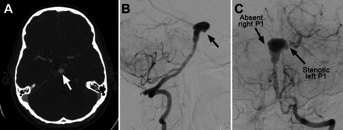 A：轴位CT血管造影显示巨大基底动脉瘤部分血栓形成。B：侧位DSA显示部分血栓形成的BTA动脉瘤。C：前后位投影显示左侧大脑后动脉（PCA）自动脉瘤发出，右侧P1段缺如，左侧P1段狭窄，双侧小脑上动脉缺如。
