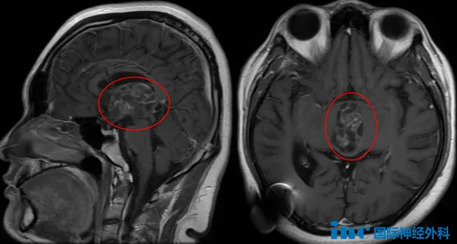 如果手术，一定要找巴教授。