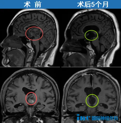 肿瘤越小做手术，预后越好，真的不能抱有侥幸心理。