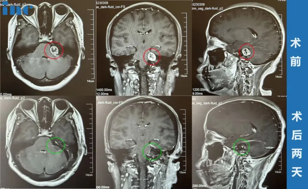 现在是最佳手术时机吗？能否安全手术？