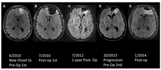 同胞1B：WHO II级少突胶质细胞瘤。患者以新发癫痫就诊，本次手术病理示少突胶质细胞瘤伴1p19q共缺失；FLAIR序列代表性图像排列方式为：上排为代表性区域。（a）初始MRI显示左侧额叶疑似肿瘤病灶。（b）次全切除术后影像。（c）术后一年FLAIR序列显示高信号轻微进展。（d）FLAIR序列显示疾病进展，本次术前扫描为后续再次切除手术制定计划。（e）全切除术后扫描图像
