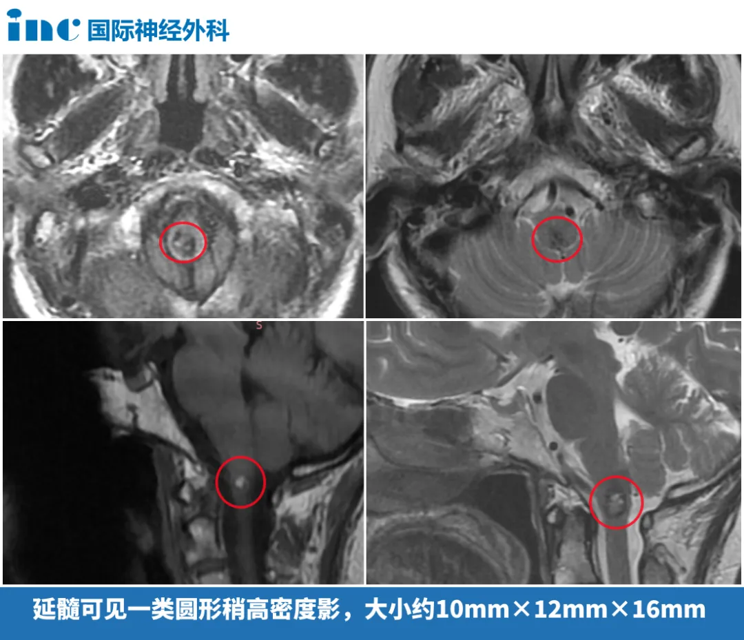 影像显示延髓区域存在一类圆形稍高密度影，尺寸约为10mm×12mm×16mm