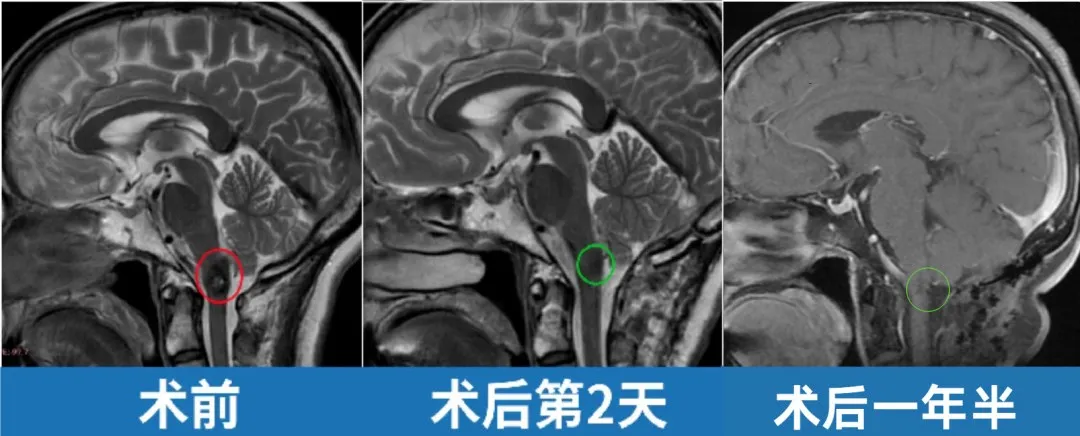 术前、术后第2天、术后一年半的影像对比