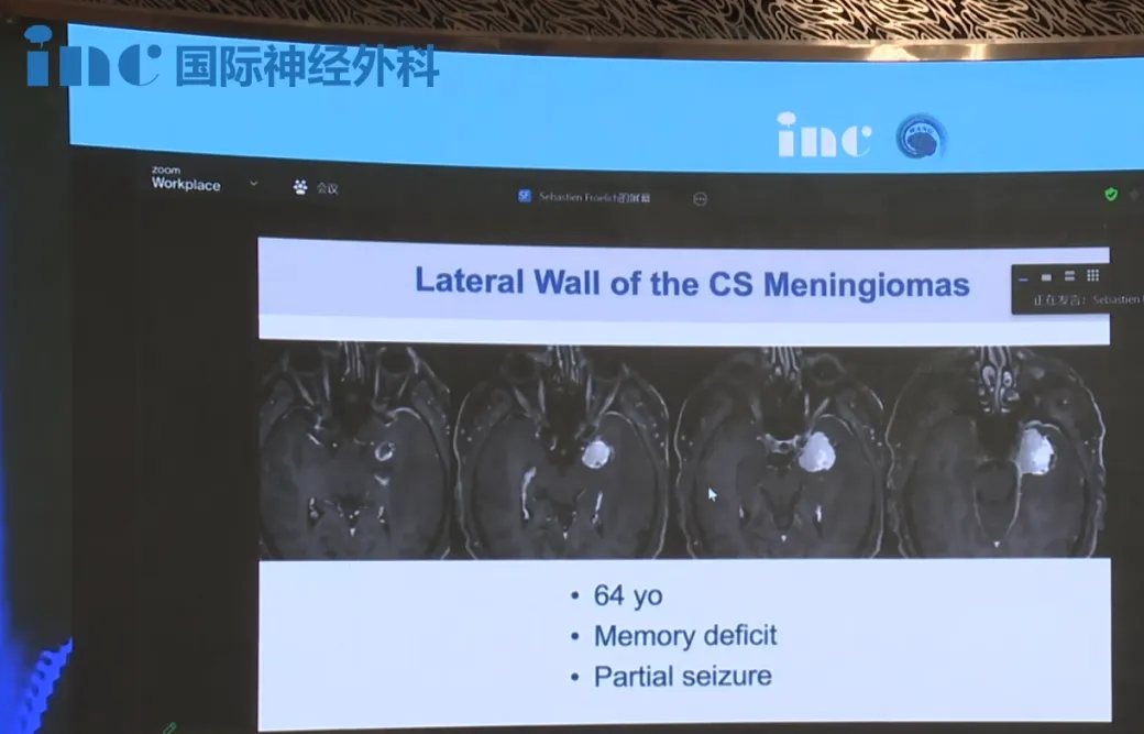 由于位于海绵窦外侧壁，经典的翼点入路成为福教授最初的考量。