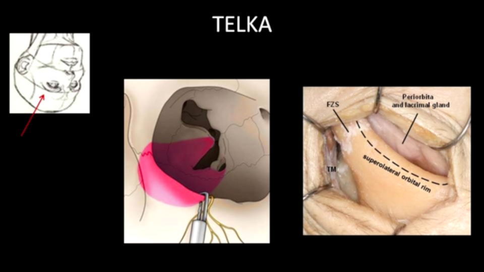 福洛里希教授希望能够保护颞叶，再加上综合考虑到肿瘤内没有包绕血管，患者秃顶且眉毛浓密，决定采用经眶入路，即从眉毛切除这个肿瘤。