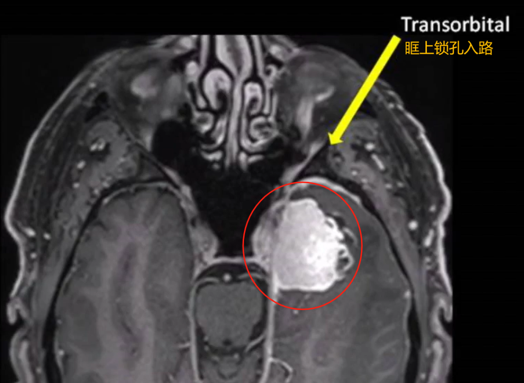 该入路可提供更好的手术视野和足够的操作空间，减少危险牵拉。