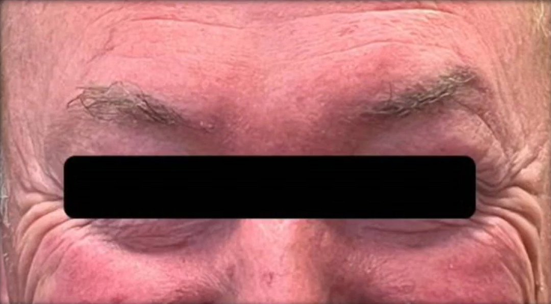 在 2 个月的随访中，疤痕几乎看不见