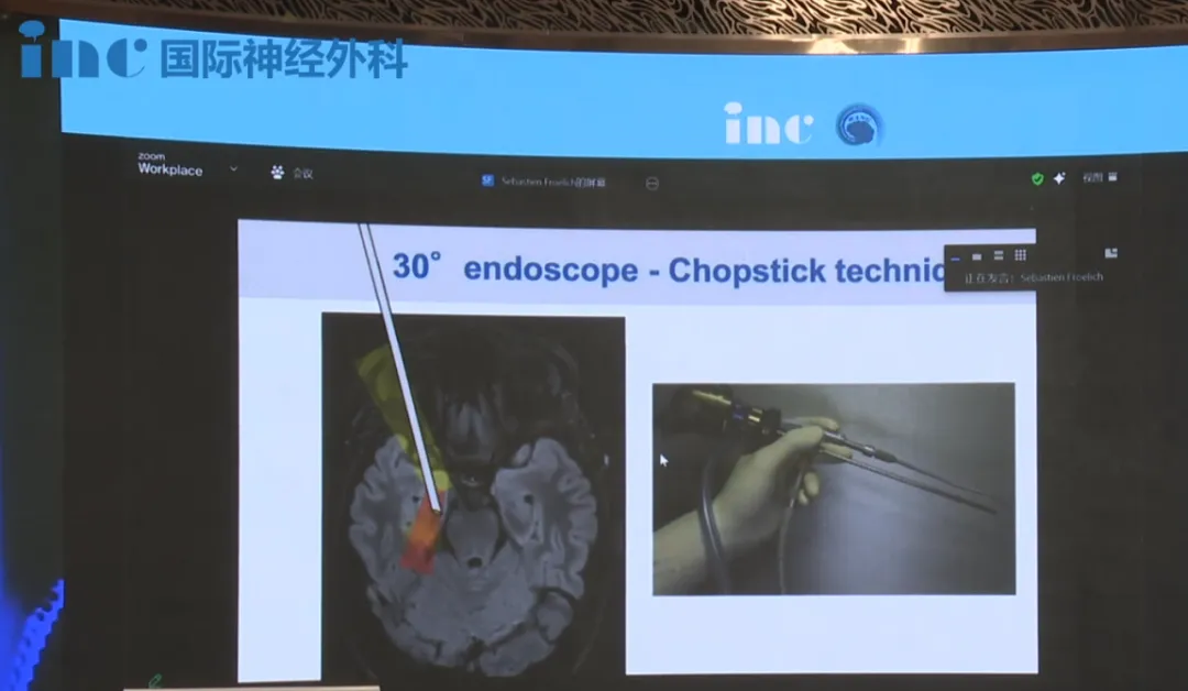 没有大脑牵拉、没有颞静脉零牺牲、神经功能得到保护