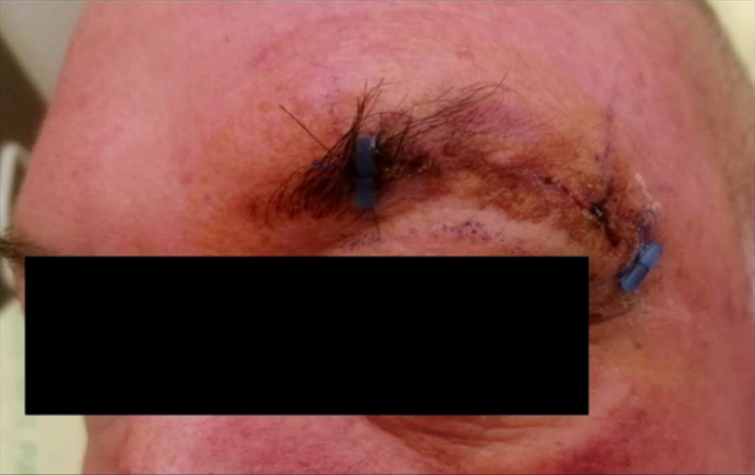 术后检查显示肿瘤全切，无手术并发症。患者未出现任何神经功能缺损。术后第6天拆线出院。