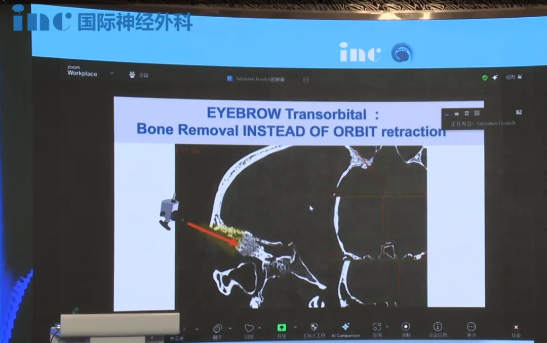 福洛里希教授分享眉弓锁孔手术