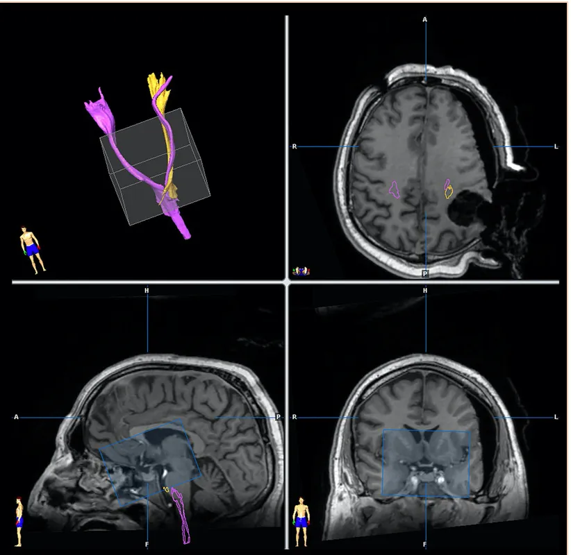 低级别胶质瘤的术中iMRI成像。进行了术前皮质脊髓束（CST）（粉红色）和术中（黄色）图像的纤维追踪：由于肿瘤切除后的移位，注意CST的不同位置非常重要