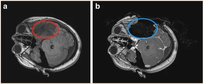 复发性左颞顶叶少突星形细胞瘤（WHO 2级）的术前MRI。b术中MRI显示病变已得到全切