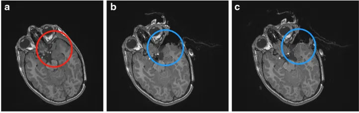 a为左颞神经节神经胶质瘤（WHO I级）的术前MRI。b为术中MRI控制显示在颞后肌膜区域残留肿瘤。c继续手术，术中第二次MRI显示病变已全切