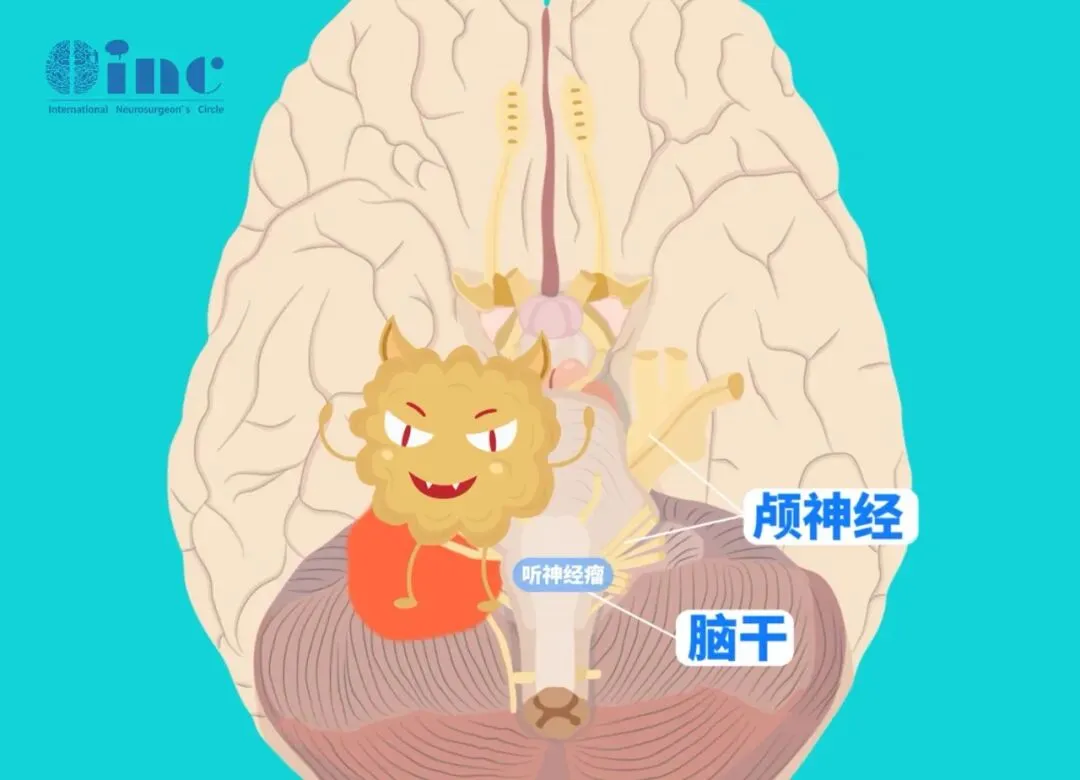 听神经瘤如果手术，会有哪些风险和并发症？