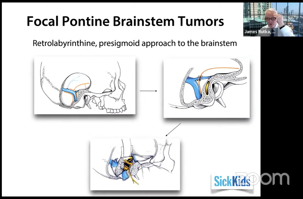 一文读懂儿童局灶性脑干胶质瘤：适合手术，长期生存率可近100%