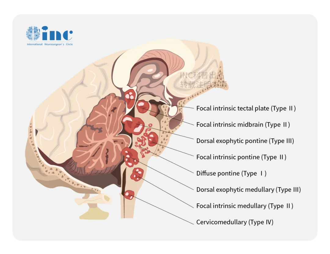 不同部位的预后