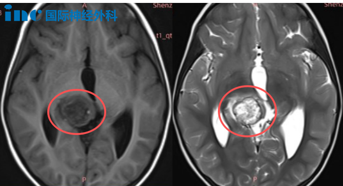 可影响孩子80%的功能！查出丘脑肿瘤，我们如何「安全下车」？
