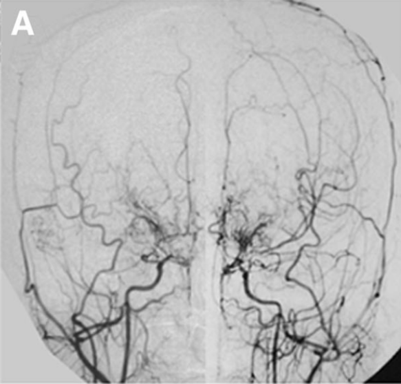 突发肢体无力以为只是太累了，没想到是两种罕见病同时找上门！