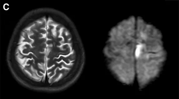 入院时术前影像学检查：T2 加权磁共振成像（左图）及弥散加权成像（右图）可见左侧额叶新发脑梗死。