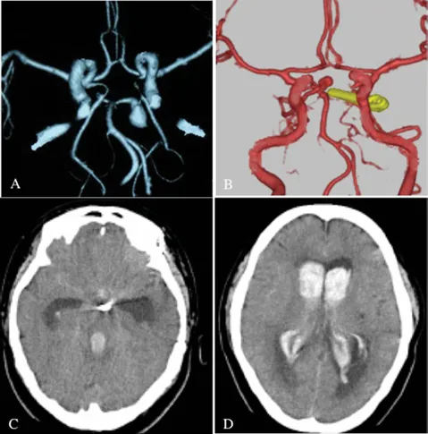 致命复发！动脉瘤术后7年，剧烈头痛过后竟让她陷入深度昏迷