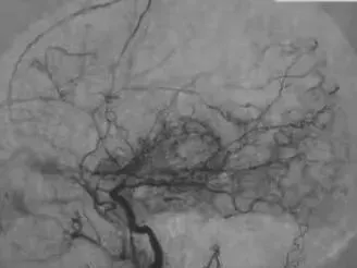 烟雾病血管造影影像