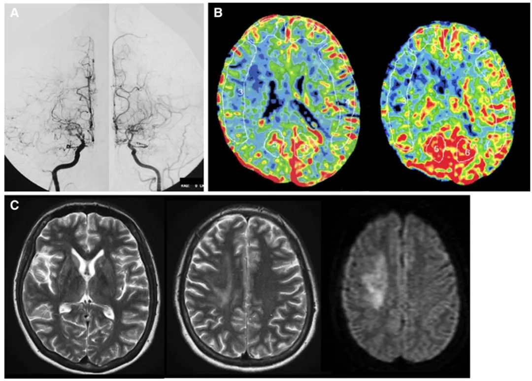 严重的甲状腺毒症状态