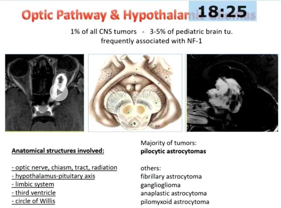 解析巴教授对该疾病的手术入路选择