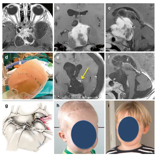 该2岁男性患儿鞍上一囊实性、显著强化的占位性病变，并延伸至左侧颞叶（a-c）。患儿经左翼点开颅入路行肿瘤切除术。皮肤切口设计时包含了既往分流手术瘢痕的一部分（d）。术后未出现新增神经功能缺损或内分泌功能障碍，术后MRI证实了该确诊为WHO II级毛黏液样星形细胞瘤的肿瘤被全切除（e,f）。（g）显示了便于暴露和切除前床突的硬膜外脑膜-眶韧带切开步骤。术后1个月（h）及2年（i），患儿临床状况保持良好。
