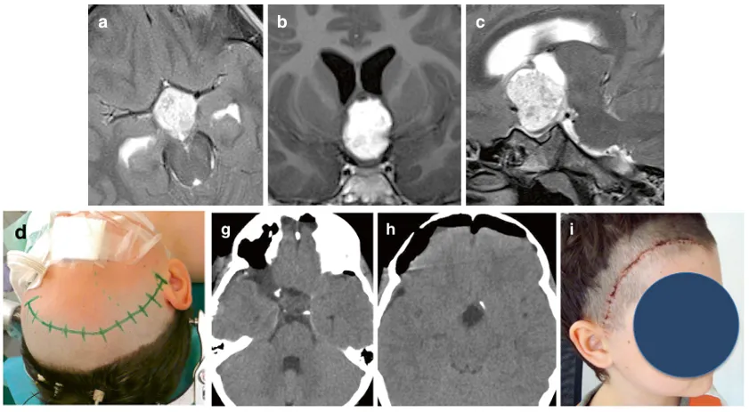 该8岁男性患儿因视路-下丘脑胶质瘤累及第三脑室并延伸至门罗孔而出现视力受损（a-c）。手术在患者仰卧位下进行（d），采用右侧眶颧开颅入路。额颞-眶颧骨瓣被整块取下，通过终板入路成功实现了肿瘤全切。术后早期CT扫描证实肿瘤完全切除，且局部无血肿形成（g，h）。患者未出现额外并发症，术后2周照片显示美容效果满意（i）。